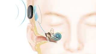 How the Cochlear Nucleus Kanso Implant System Works