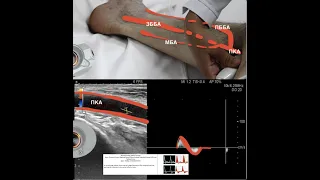 Ультразвуковое исследование  аорты, артерий подвздошных нижних  конечностей