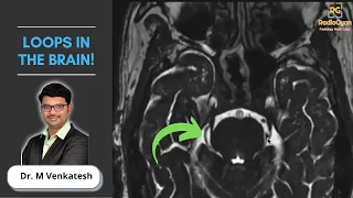 Imaging of Neurovascular Conflict (Trigeminal Neuralgia) | Dr. Venkatesh M
