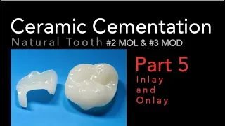 Lithium Disilicate Ceramics, Part  5: Cementation of Inlay and Onlay