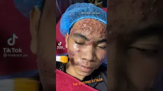 Acne peeling