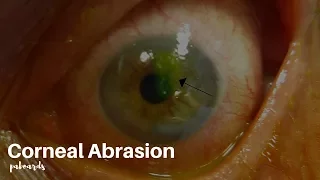 Eye injuries: Corneal abrasion