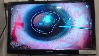 Dr Hitesh Ramanuj (Ahmedabad, Gujarat, INDIA) - Phenocaine Assisted Cataract Surgery