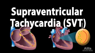 Supraventricular Tachycardia (SVT, PSVT), Animation