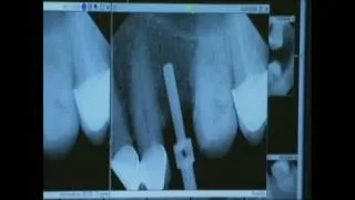 Nobel Active Implant Surgery with Immediate Temporization