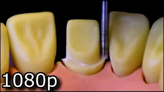 All Ceramic Crown Preparation For Upper Central (Maxillary) Incisor.