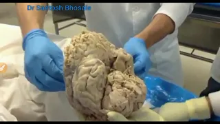 Dissection of Cranial cavity - Meninges, Dural folds, Dural venous sinuses & Cranial nerves