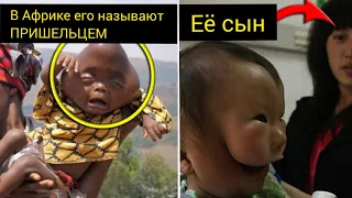 15 Самых необычных людей, родившихся с самыми необычными особенностями