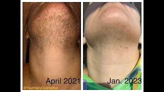 127 Hours:  Recap of my ENTIRE electrolysis permanent facial hair removal | PCOS & Hirsutism support