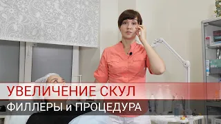 Увеличение скул филлерами.