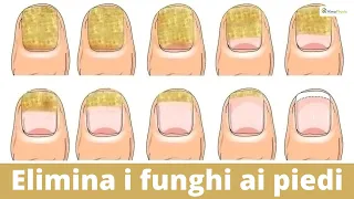 Come eliminare i funghi sotto le unghie (E NON FARLI PIU' TORNARE!!!)