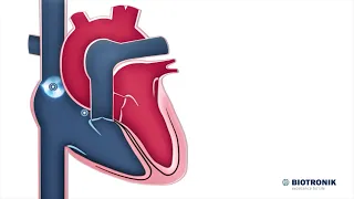 Système électrique du cœur | Animation médicale