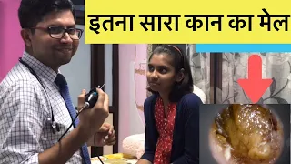 How to Remove Earwax best and easy way without pain