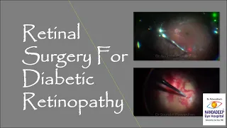 Cataract surgery with Retinal surgery for Diabetic retinopathy Dr Sourabh Patwardhan.call 9220001000