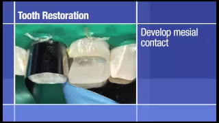 Anterior Restoration: Dual-Shade Build-Up Restoration of Two Anterior Teeth