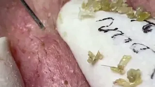 🔴LIVE BLACKHEAD EXTRACTION REMOVAL #blackheads #acne #pimplepopping #whiteheads #asmr