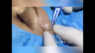 Dr. Wong demonstrates cosmetic facial mole removal minimal scar technique