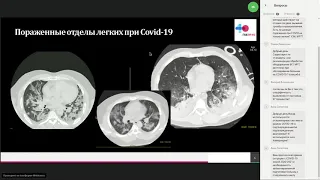 Рентгенография при COVID-19. Опыт ГКБ №40 ДЗМ (Коммунарка)