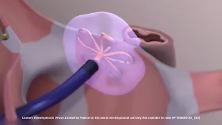 FARAPULSE™ Pulsed Field Ablation System Animation