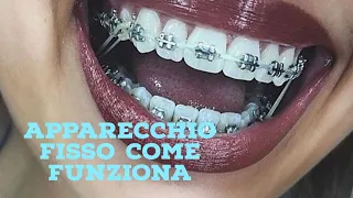 Apparecchio ortodontico fisso come funziona