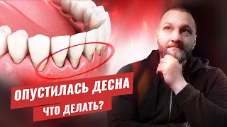 🇺🇦 Опустилась десна, что делать