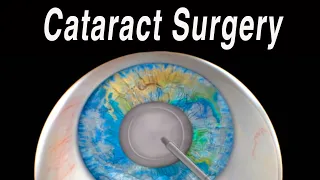 Cataract Eye Surgery Animation