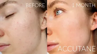 1 MONTH ACCUTANE JOURNEY PROGRESS FOR MILD ACNE | SIDE EFFECTS & SKINCARE