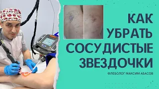 Как избавиться от сосудистых звездочек? Флеболог Москва.