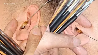 Giant ear wax | Comfortably relax with earwax removal in Vietnam