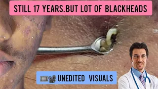 Blackheads extraction in a young male | #blackheads #blackheadremoval @Dr.AMAZINGSKIN