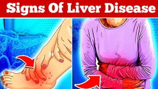 6 Alarming Signs Of Liver Damage Nobody Ever Told You