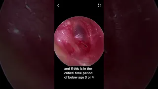 Ear Tube Surgery: Real Surgery Explanation
