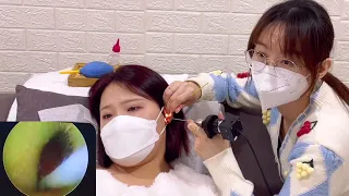 엄청 편안하고 깨끗한 내시경귀청소/Very comfortable and clean endoscopic ear cleaning/とても快適で清潔な内視鏡の耳掃除