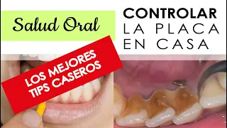 como CONTROLAR el SARRO  🙋‍♀️  dental en CASA si no puedes ir al ODONTÓLOGO 👩‍⚕️