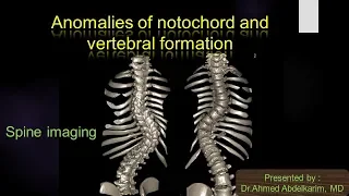 3-Anomalies of the notochord and vertebral formation