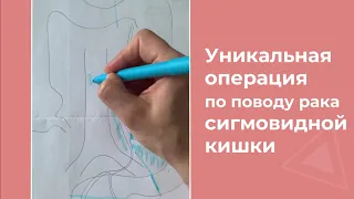 Как сохранить кишечник при раке сигмовидной кишки