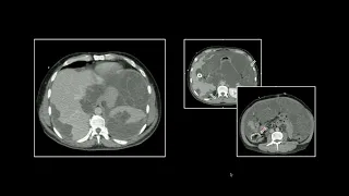 “Instant Diagnosis” Emergency Neoplasm Presentations 3 | 15 Minute Radiology CME