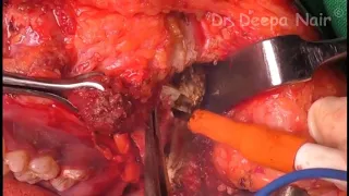 24   TOTAL MAXILLECTOMY WITH INFRATEMPORAL FOSSA CLEARANCE by Dr  Florida Sharin