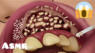 Asmr Animaçao removendo larvas vivas de boca infectada | animation video