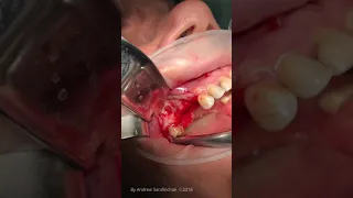 micro Sinuslift and implant placement