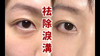How to get rid of   Under eye bags/ make the Puffy Eyes disappear 