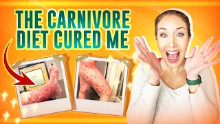 The Carnivore Diet Cured Me!