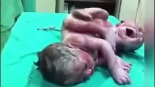 Twin Newborn Babies Birth Defects