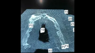 🇮🇹DENTAL IMPLANT CENTER NET🇮🇹 Intervento | Inserimento di micro impianti conometrici Bicon