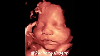 3D Ultrasound Scan of a Baby Boy at 31 Weeks with gender reveal