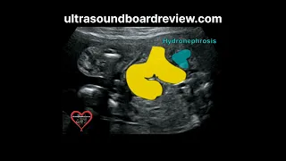 Hydronephrosis Fetal Ultrasound