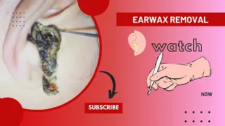 Ear Cleaning Relaxing Video (Huge Earwax)