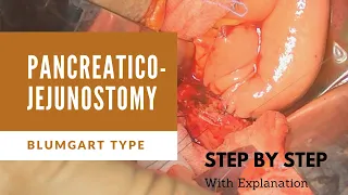 How to do Pancreatico-Jejunostomy? Blumgart style anastomosis explained step by step.