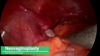 Modified Vecchietti vaginoplasty using self-made single-port laparoscopy in MRKH syndrome