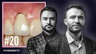 THE WHOLE TRUTH ABOUT VENEERS. Complications in dentistry / KAMINSKYI